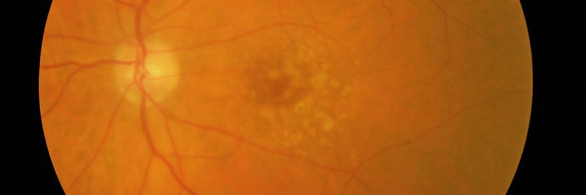Image médicale d’un œil atteint de dégénérescence maculaire liée à l’âge