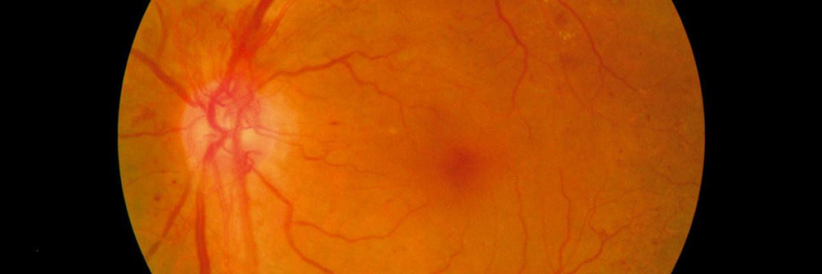 Medical scan of eye with diabetic retinopathy 