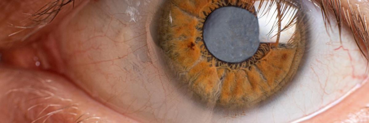Close-up of an eye with cataracts