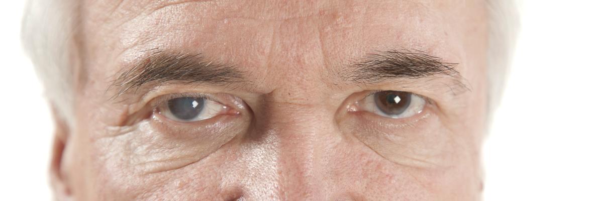 Image des yeux d’un homme, dont l’un est affecté par le glaucome