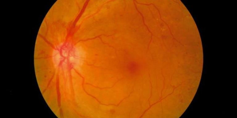 Medical scan of eye with diabetic retinopathy 