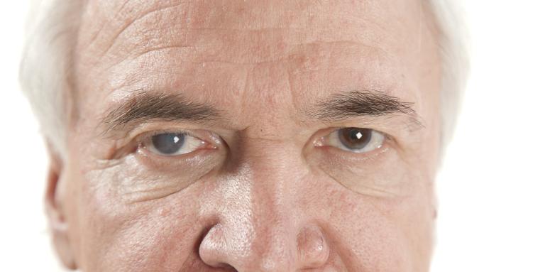 Image of man’s eyes, one of which is affected by glaucoma