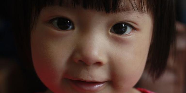 Amblyopia (commonly known as “lazy eye”) happens when the vision in one eye doesn't develop properly in early childhood
